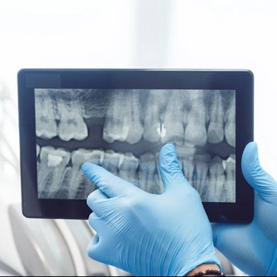 Advanced 3D imaging for precise and safe dental implant planning